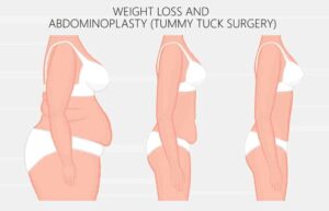 how to get a tummy tuck for free