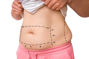 how to get a free tummy tuck surgery