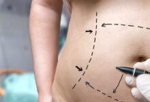 How To Get Insurance To Cover Tummy Tuck