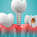 What You Can and Can't Eat with Dentures