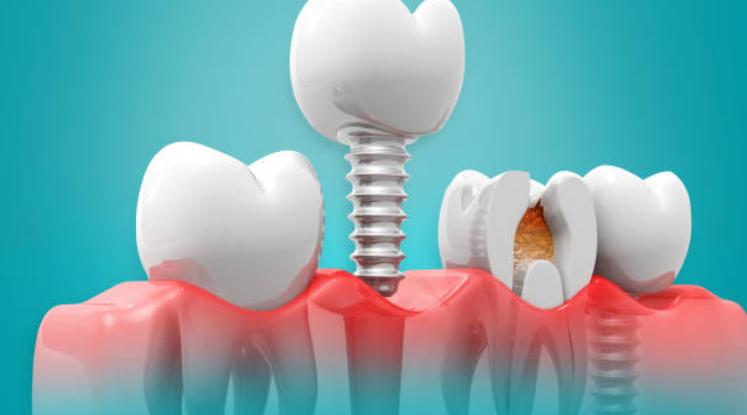 What You Can and Can't Eat with Dentures